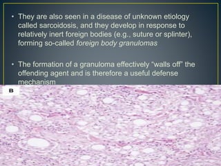• They are also seen in a disease of unknown etiology
called sarcoidosis, and they develop in response to
relatively inert foreign bodies (e.g., suture or splinter),
forming so-called foreign body granulomas
• The formation of a granuloma effectively “walls off” the
offending agent and is therefore a useful defense
mechanism
 
