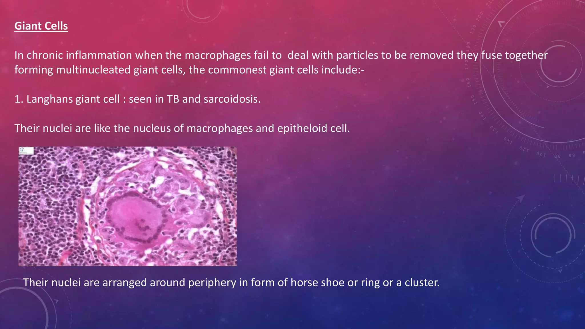 Giant Cells
In chronic inflammation when the macrophages fail to deal with particles to be removed they fuse together
forming multinucleated giant cells, the commonest giant cells include:-
1. Langhans giant cell : seen in TB and sarcoidosis.
Their nuclei are like the nucleus of macrophages and epitheloid cell.
Their nuclei are arranged around periphery in form of horse shoe or ring or a cluster.
 