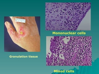 Mononuclear cells
Mixed cells
Granulation tissue
 
