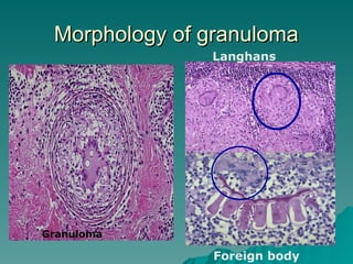 Morphology of granuloma
Morphology of granuloma
Granuloma
Langhans
Foreign body
 