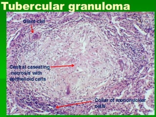 Chronic inflammation