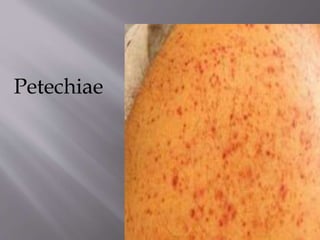 Chronic itp | PPTX