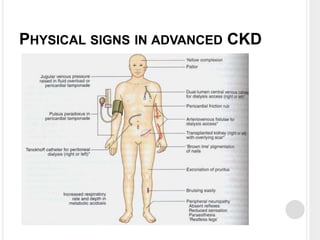 Chronic Kidney Disease (CKD) | PPTX