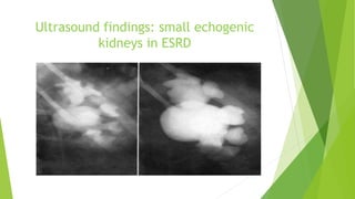 Ultrasound findings: small echogenic
kidneys in ESRD
 