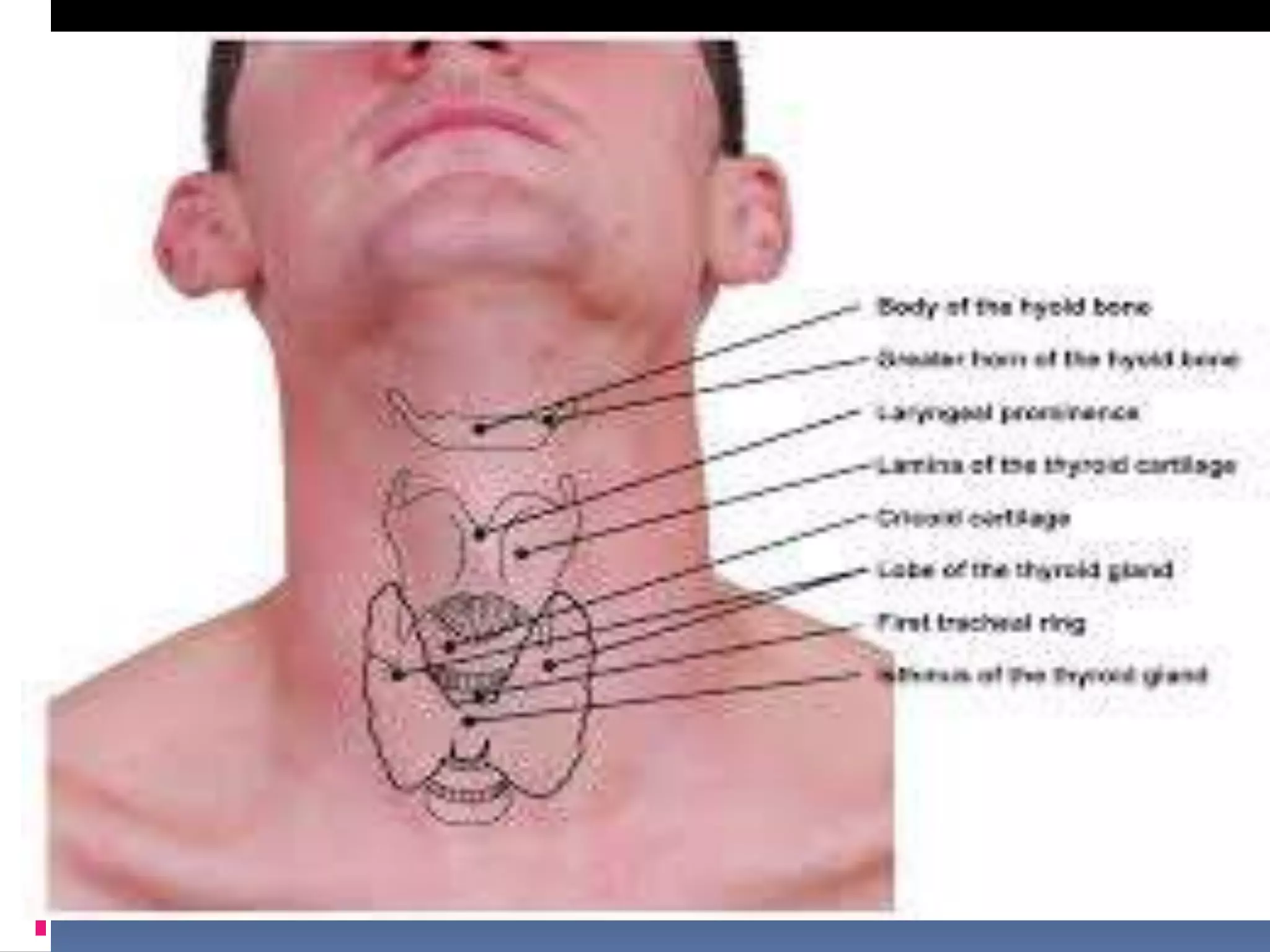 Laryngitis Persistent Chronic laryngeal infections | PPTX