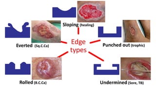 Edge
types
Sloping (healing(
Punched out (trophic)
Undermined (Sore, TB)Rolled (B.C.Ca)
Everted (Sq.C.Ca)
 