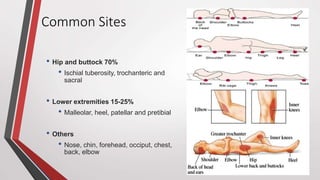 Common Sites
• Hip and buttock 70%
• Ischial tuberosity, trochanteric and
sacral
• Lower extremities 15-25%
• Malleolar, heel, patellar and pretibial
• Others
• Nose, chin, forehead, occiput, chest,
back, elbow
 