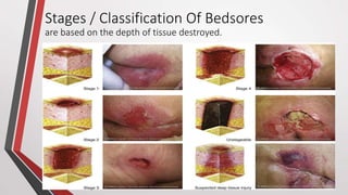 Stages / Classification Of Bedsores
are based on the depth of tissue destroyed.
 