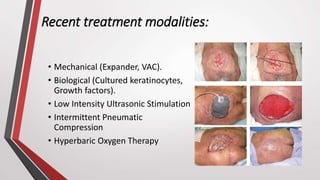 Recent treatment modalities:
• Mechanical (Expander, VAC).
• Biological (Cultured keratinocytes,
Growth factors).
• Low Intensity Ultrasonic Stimulation
• Intermittent Pneumatic
Compression
• Hyperbaric Oxygen Therapy
 