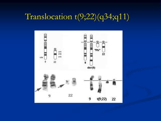 Translocation t(9;22)(q34;q11)
 