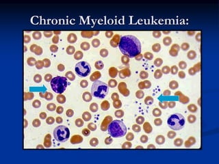 Chronic Myeloid Leukemia:
 