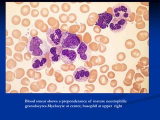 Blood smear shows a preponderance of mature neutrophilic
granulocytes.Myelocyte at center, basophil at upper right
 
