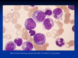Blood smear showing a greater left shift. At center is a myeloblast
 