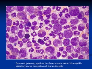 Increased granulocytopoiesis in a bone marrow smear. Neutrophilic
granulocytes,two basophils, and four eosinophils
 