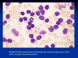Peripheral blood smears show predominantly mature lymphocytes, some
with a clumped chromatin pattern
 
