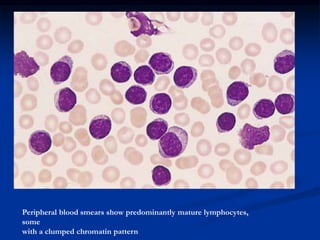 Peripheral blood smears show predominantly mature lymphocytes,
some
with a clumped chromatin pattern
 