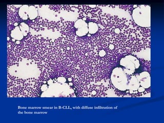 Bone marrow smear in B-CLL, with diffuse infiltration of
the bone marrow
 