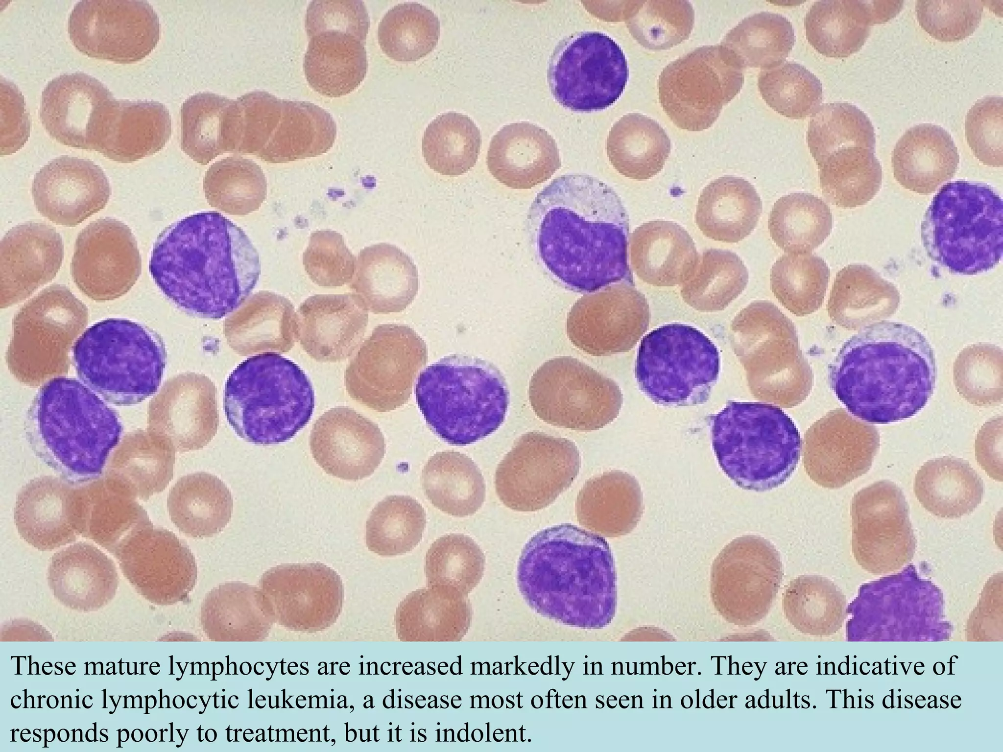 These mature lymphocytes are increased markedly in number. They are indicative of
chronic lymphocytic leukemia, a disease most often seen in older adults. This disease
responds poorly to treatment, but it is indolent.
 