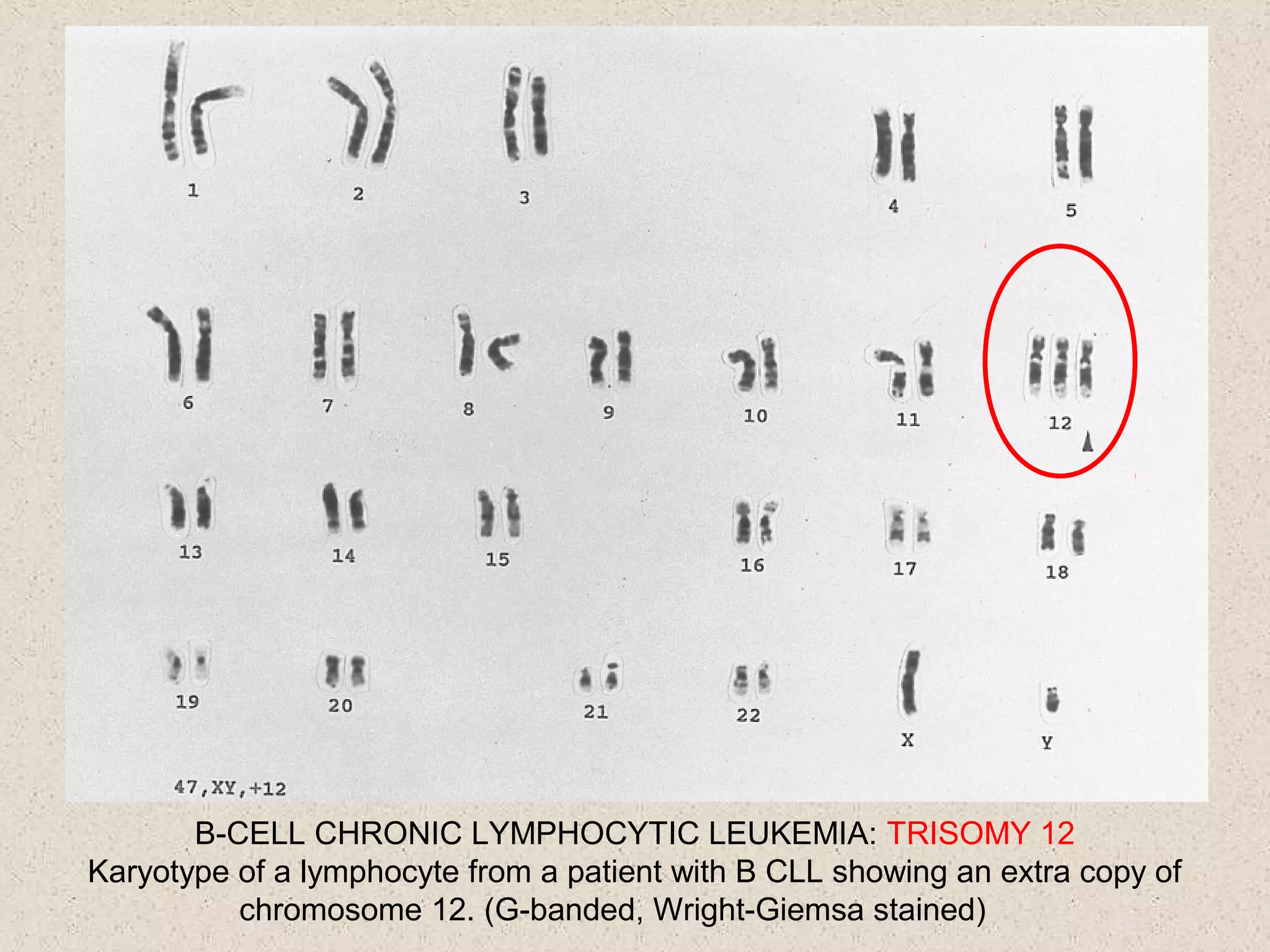 B-CELL CHRONIC LYMPHOCYTIC LEUKEMIA: TRISOMY 12
Karyotype of a lymphocyte from a patient with B CLL showing an extra copy of
chromosome 12. (G-banded, Wright-Giemsa stained)
 