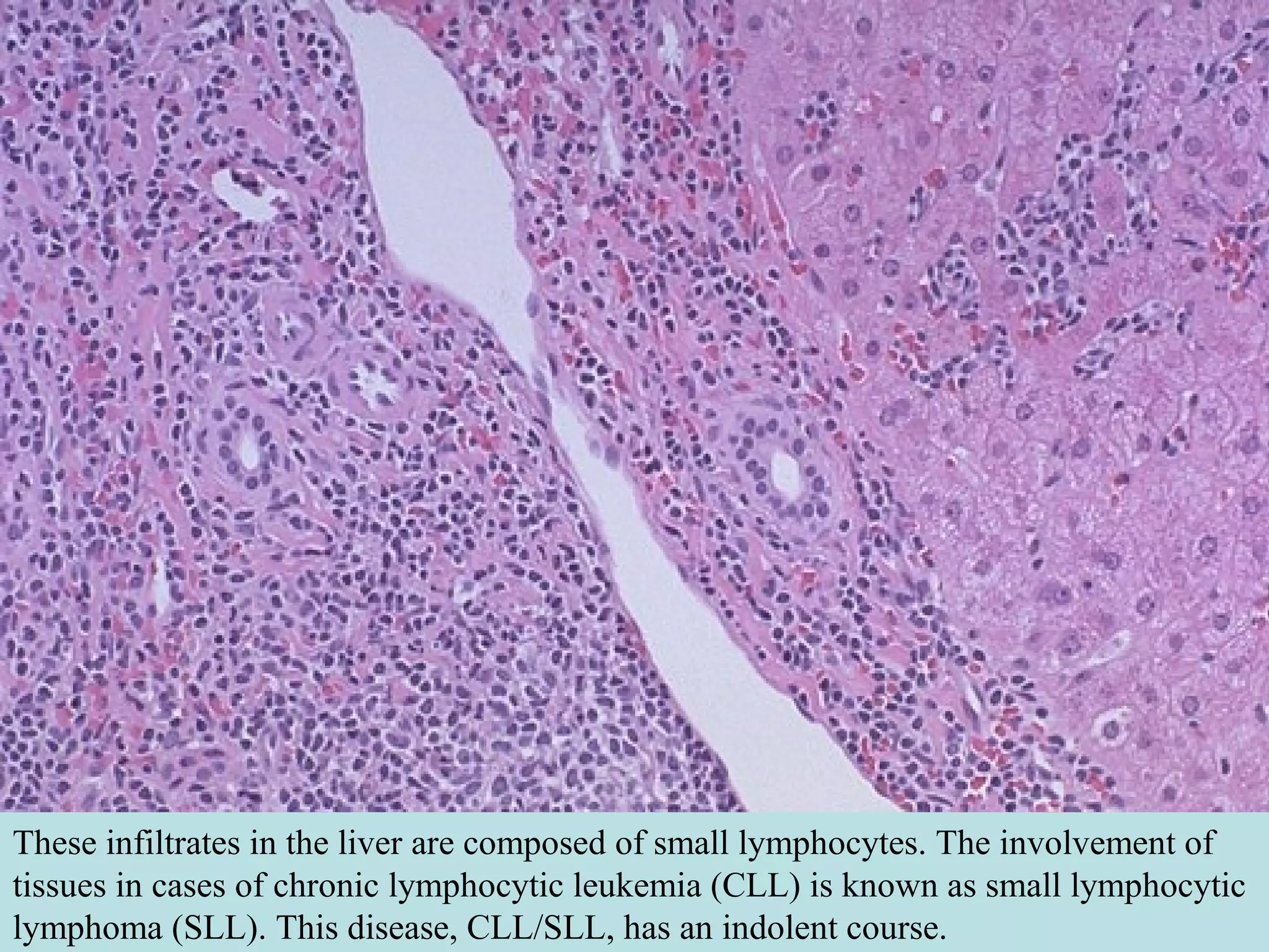 These infiltrates in the liver are composed of small lymphocytes. The involvement of
tissues in cases of chronic lymphocytic leukemia (CLL) is known as small lymphocytic
lymphoma (SLL). This disease, CLL/SLL, has an indolent course.
 