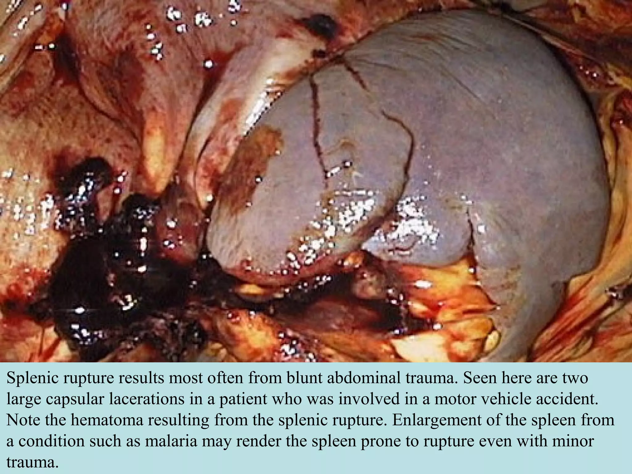Splenic rupture results most often from blunt abdominal trauma. Seen here are two
large capsular lacerations in a patient who was involved in a motor vehicle accident.
Note the hematoma resulting from the splenic rupture. Enlargement of the spleen from
a condition such as malaria may render the spleen prone to rupture even with minor
trauma.
 