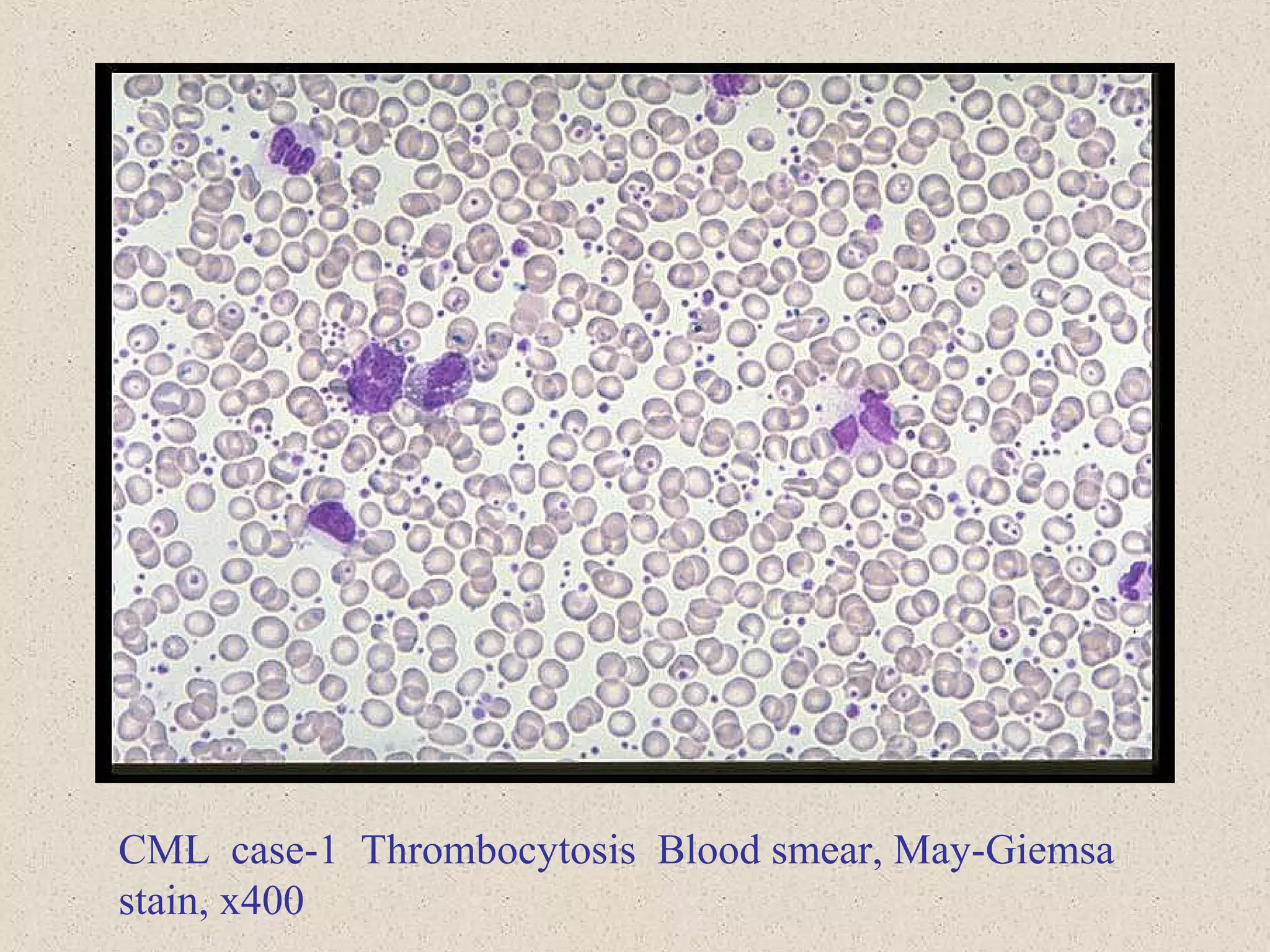 CML case-1 Thrombocytosis Blood smear, May-Giemsa
stain, x400
 