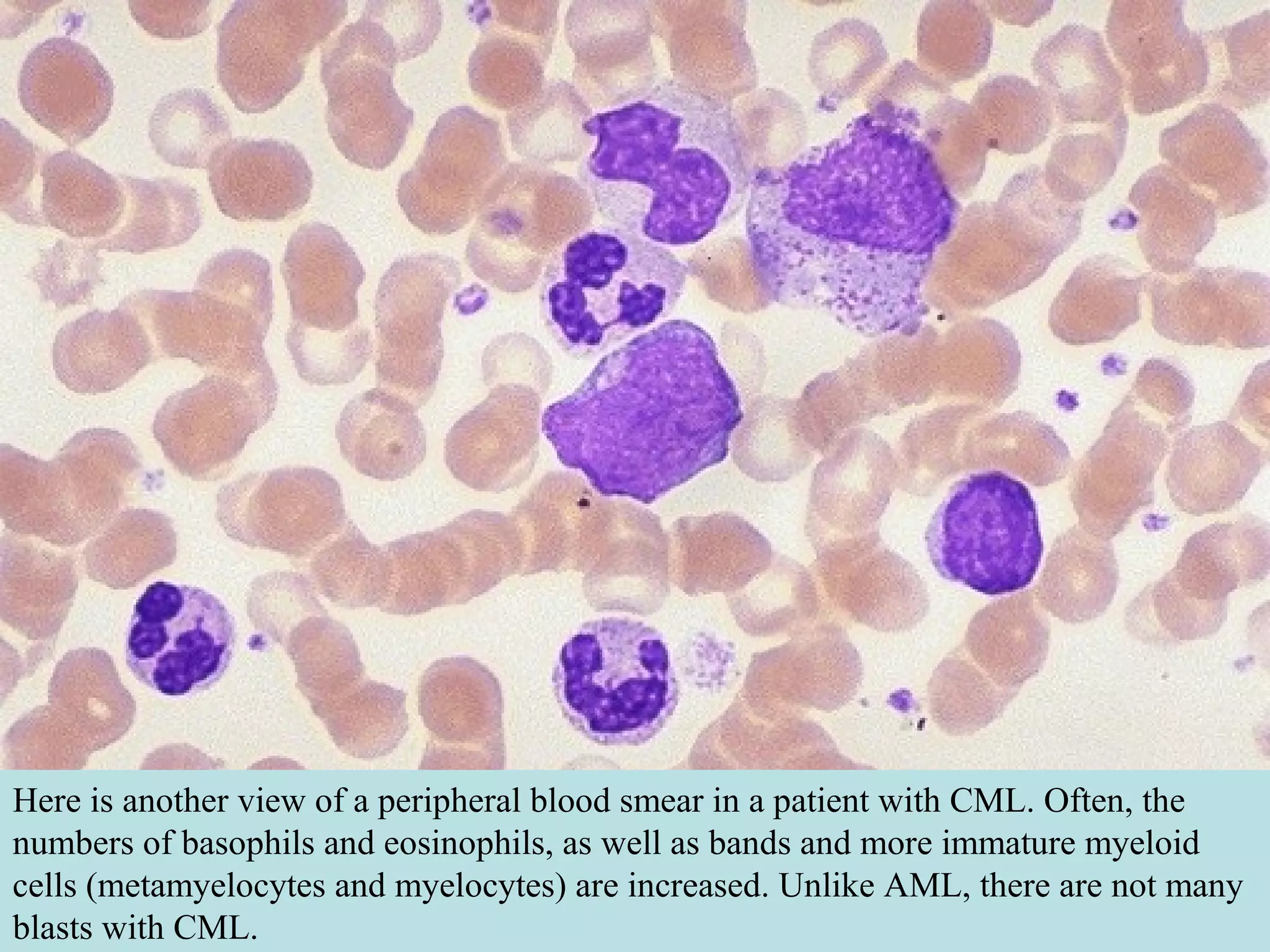 Here is another view of a peripheral blood smear in a patient with CML. Often, the
numbers of basophils and eosinophils, as well as bands and more immature myeloid
cells (metamyelocytes and myelocytes) are increased. Unlike AML, there are not many
blasts with CML.
 