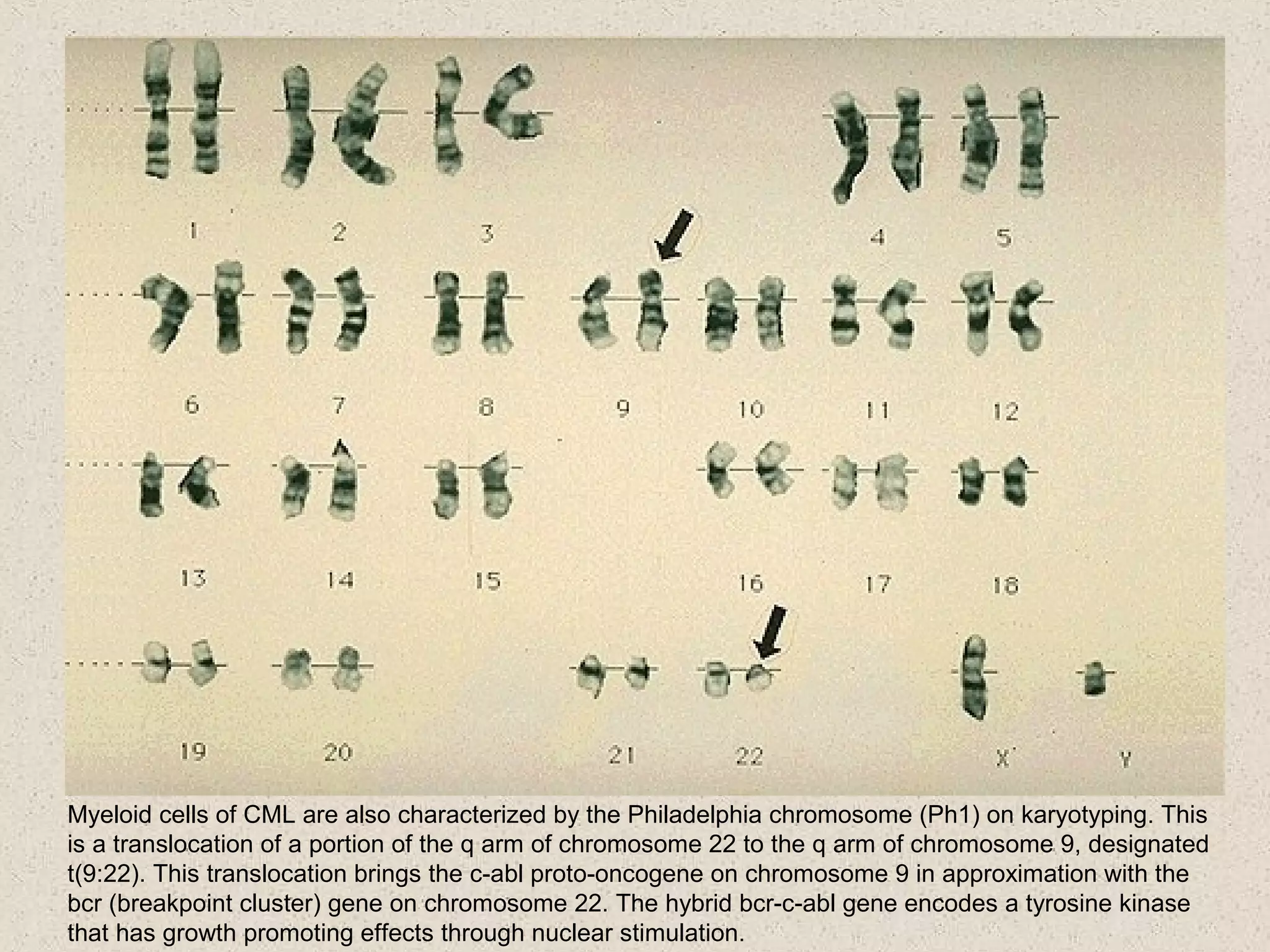 Myeloid cells of CML are also characterized by the Philadelphia chromosome (Ph1) on karyotyping. This
is a translocation of a portion of the q arm of chromosome 22 to the q arm of chromosome 9, designated
t(9:22). This translocation brings the c-abl proto-oncogene on chromosome 9 in approximation with the
bcr (breakpoint cluster) gene on chromosome 22. The hybrid bcr-c-abl gene encodes a tyrosine kinase
that has growth promoting effects through nuclear stimulation.
 