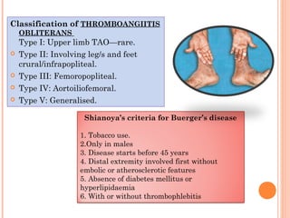 Classification of THROMBOANGIITIS
OBLITERANS
Type I: Upper limb TAO—rare.
 Type II: Involving leg/s and feet
crural/infrapopliteal.
 Type III: Femoropopliteal.
 Type IV: Aortoiliofemoral.
 Type V: Generalised.
Shianoya’s criteria for Buerger’s disease
1. Tobacco use.
2.Only in males
3. Disease starts before 45 years
4. Distal extremity involved first without
embolic or atherosclerotic features
5. Absence of diabetes mellitus or
hyperlipidaemia
6. With or without thrombophlebitis
 