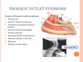 THORACIC OUTLET SYNDROME
Causes of thoracic outlet syndrome
 Cervical rib
 Long C7 transverse process
 Anomalous insertion of scalene
muscles
 Scalene muscle hypertrophy
 Scalene minimus
 Abnormal bands and ligaments
 Fracture clavicle or first rib
 Exostosis
 Tumours in the region
Cervical rib
 