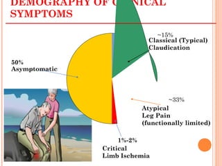 DEMOGRAPHY OF CLINICAL
SYMPTOMS
~15%
Classical (Typical)
Claudication
~33%
Atypical
Leg Pain
(functionally limited)
50%
Asymptomatic
1%-2%
Critical
Limb Ischemia
 
