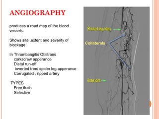 ANGIOGRAPHY
produces a road map of the blood
vessels.
Shows site ,extent and severity of
blockage
In Thrombangitis Oblitrans
corkscrew apperance
Distal run-off
inverted tree/ spider leg apperance
Corrugated , ripped artery
TYPES
Free flush
Selective
Collaterals
 