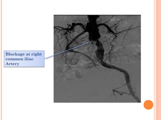 Blockage at right
common iliac
Artery
 