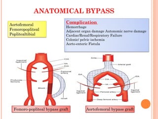 ANATOMICAL BYPASS
Femoro-popliteal bypass graft Aortofemoral bypass graft
Aortofemoral
Femoropopliteal
Poplitealtibial
Complication
Hemorrhage
Adjacent organ damage Autonomic nerve damage
Cardiac/Renal/Respiratory Failure
Colonic/ pelvic ischemia
Aorto-enteric Fistula
 