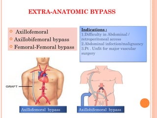 EXTRA-ANATOMIC BYPASS
 Axillofemoral
 Axillobifemoral bypass
 Femoral-Femoral bypass
Axillobifemoral bypassAxillofemoral bypass
Indications :
1.Difficulty in Abdominal /
retroperitoneal access
2.Abdominal infection/malignancy
3.Pt . Unfit for major vascular
surgery
 