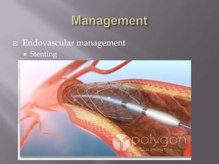  Endovascular management
 Stenting
 