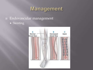  Endovascular management
 Stenting
 