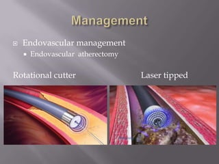  Endovascular management
 Endovascular atherectomy
Rotational cutter Laser tipped
 