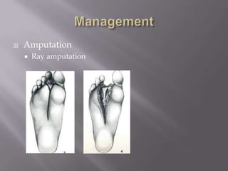  Amputation
 Ray amputation
 