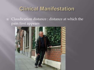  Claudication distance : distance at which the
pain first appears
 