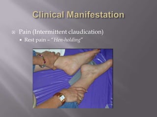  Pain (Intermittent claudication)
 Rest pain – “Hen-holding”
 