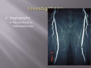  Angiography
 Site of block in
Atherosclerosis
 