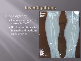  Angiography
 Cork-screw pattern of
vessels in TAO
 Block at multiple sites
in small and medium
sized arteries
 