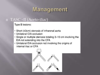  TASC –II (Aorto-iliac)
 