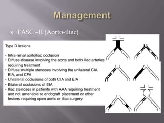  TASC –II (Aorto-iliac)
 