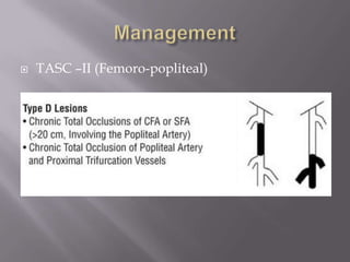  TASC –II (Femoro-popliteal)
 