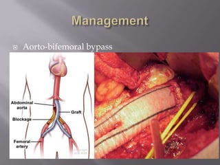  Aorto-bifemoral bypass
 