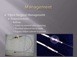  Open Surgical Management
 Endarterectomy
 Balloon
 Artery is exposed after clamping
 Proximal arteriotomy is made
 Fogarty ballon catheter is passed
 