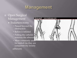  Open Surgical
Management
 Endarterectomy
 Passed beyond the
obstruction
 Ballon is inflated
 Pulling the catheter
removes the atheroma
 More commonly used
for emboli (as they are
comparetively loosely
adherant)
 