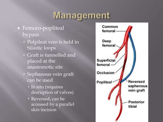  Femoro-popliteal
bypass
 Polpileat vein is held in
Silastic loops
 Graft is tunnelled and
placed at the
anastomotic site
 Sephanous vein graft
can be used
 In situ (requires
desruption of valves)
 Reversed, can be
accessed by a parallel
skin incision
 